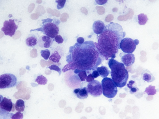 Hodgkin lymphoma cells