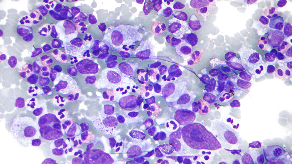 Micrograph of Hodgkin lymphoma