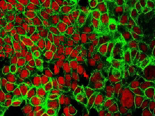 Human Colon Cancer Cells - bowel cancer 547x410px Human colon cancer cells with the cell nuclei stained red and the protein E-cadherin stained green.