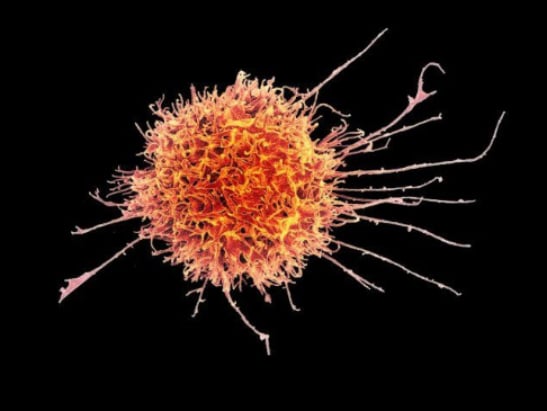 Colourised scanning electron micrograph of a natural killer cell from a human donor