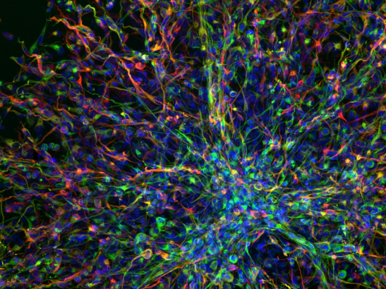 human paediatric brain tumour cells 547x410