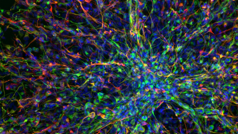 human paediatric brain tumour cells 945x532