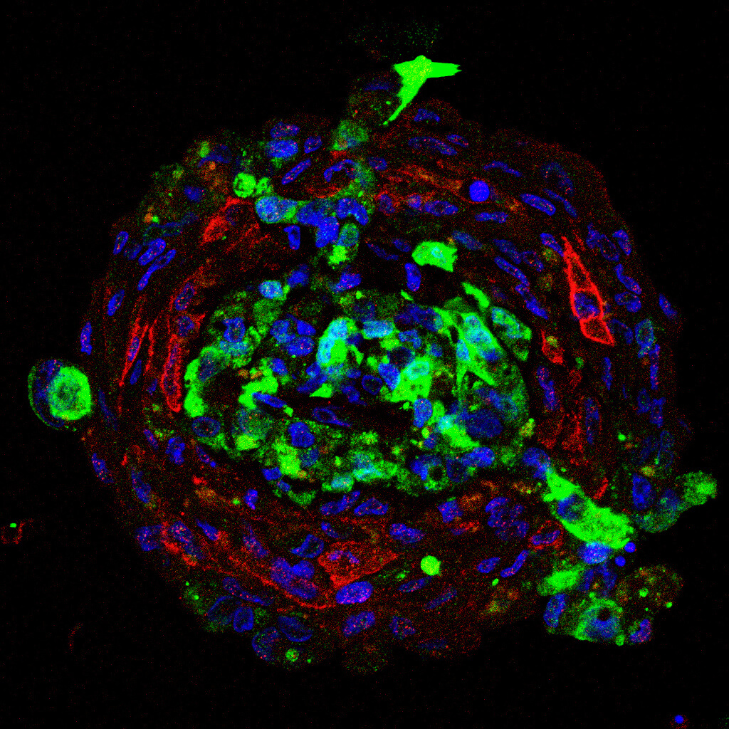 3D tumour spheroids of an aggressive soft tissue sarcoma, Desmoplastic Small Round Cell Tumours