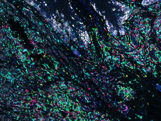 Image shows immune cells interacting with a tumour