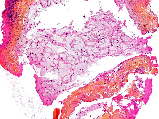 Intermediate magnification micrograph of a chordoma. HPS stain