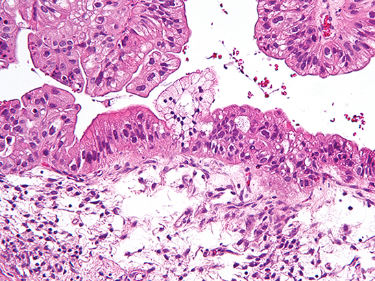 Intermediate magnification micrograph of a low malignant potential (LMP) mucinous ovarian tumour