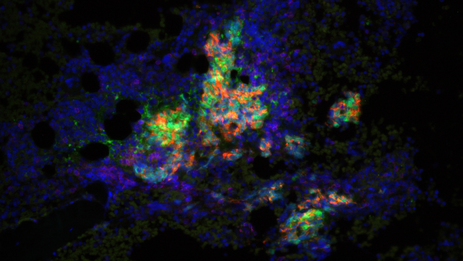 Johann de Bono and Mateus Crespo Prostate cancer cells 945x532