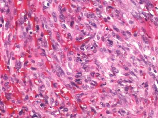 Kaposi sarcoma by Yale Rosen