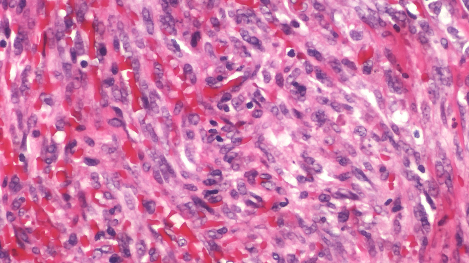 Kaposi sarcoma by Yale Rosen 945x532