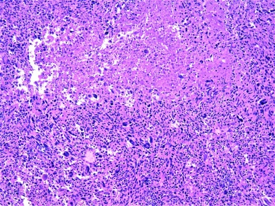 Histopathology image of Leiomyosarcoma