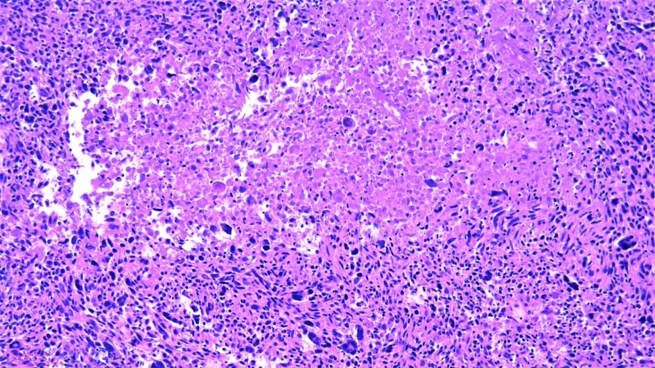 Histopathology image of leiomyosarcoma