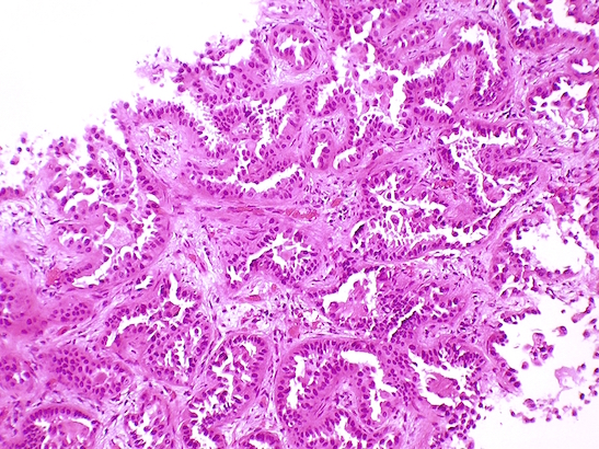 Biopsy of lung adenocarcinoma tissue