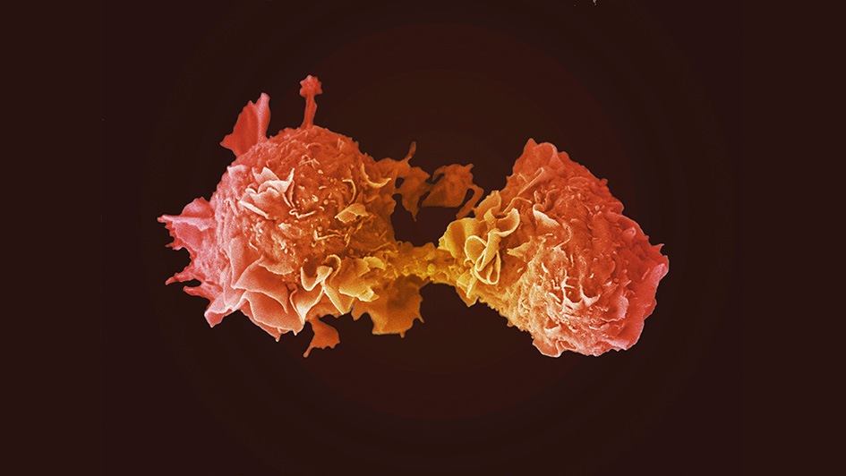 Lung cancer cells dividing Lung cancer cells dividing