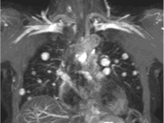 lung MRI