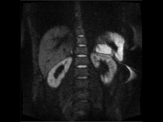 Median vs Mean DW MRI