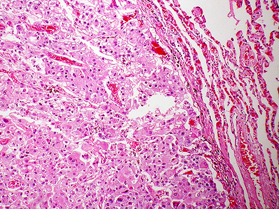 Metastatic hepatocellular carcinoma (photo: Yale Rosen (CC BY-SA 2.0)