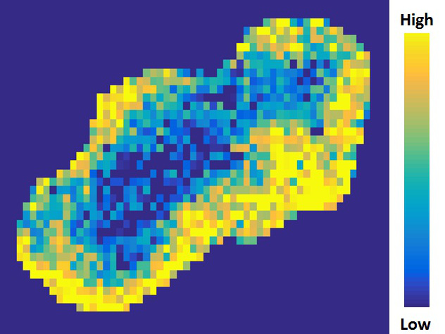 MRI image - hypoxia