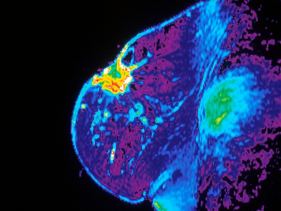 MRI of breast cancer