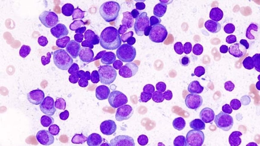 Histopathological image of multiple myeloma.