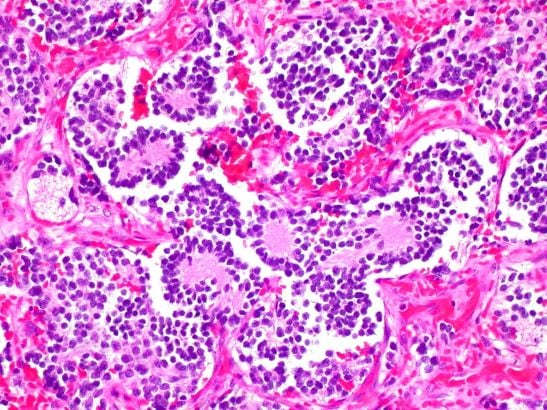 Neuroblastoma in Adrenal Gland