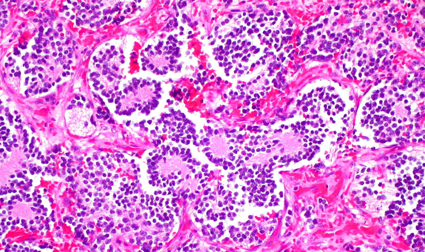 Neuroblastoma of the Adrenal Gland