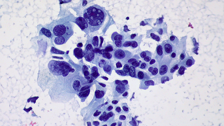 Non-small cell lung cancer (photo Dr Ed Uthman/Yale Rosen/Flickr)