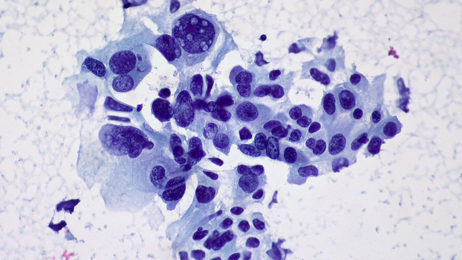 Non-small cell lung cancer (photo Dr Ed Uthman)