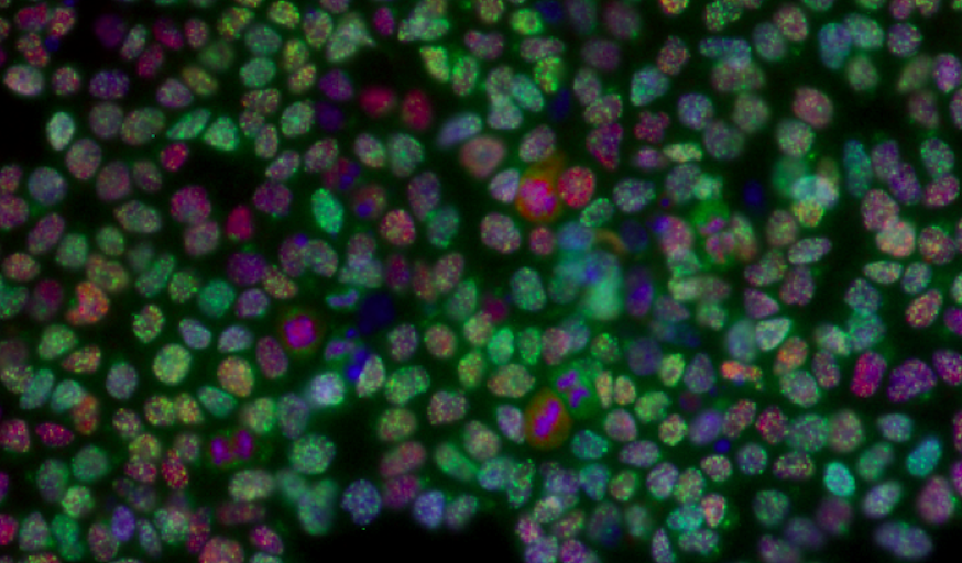 Nuclei of tumour cells stained with a blue dye and two markers of DNA damage resulting from irradiation