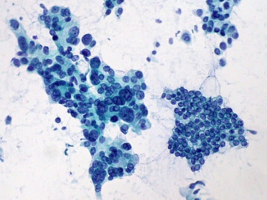 Adenocarcinoma vs. normal ductal epithelium, Ed Uthman 547x410