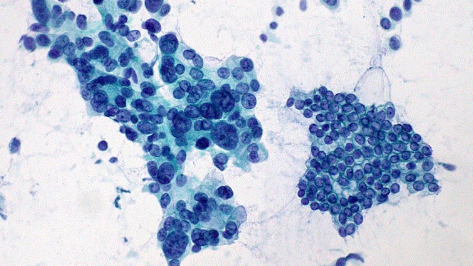 Adenocarcinoma vs. normal ductal epithelium, Ed Uthman