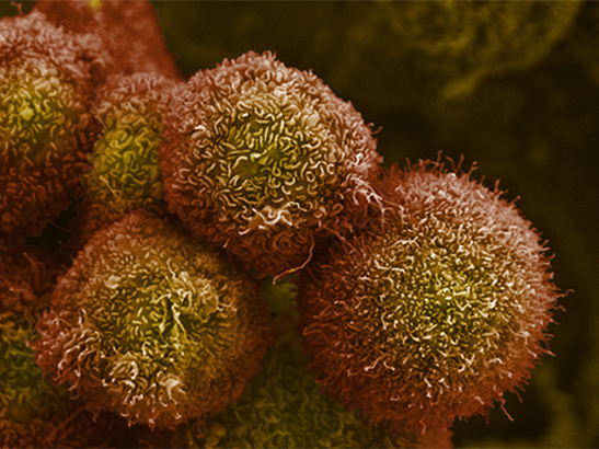 A false colour SEM image of pancreatic cancer cells, grown in culture.