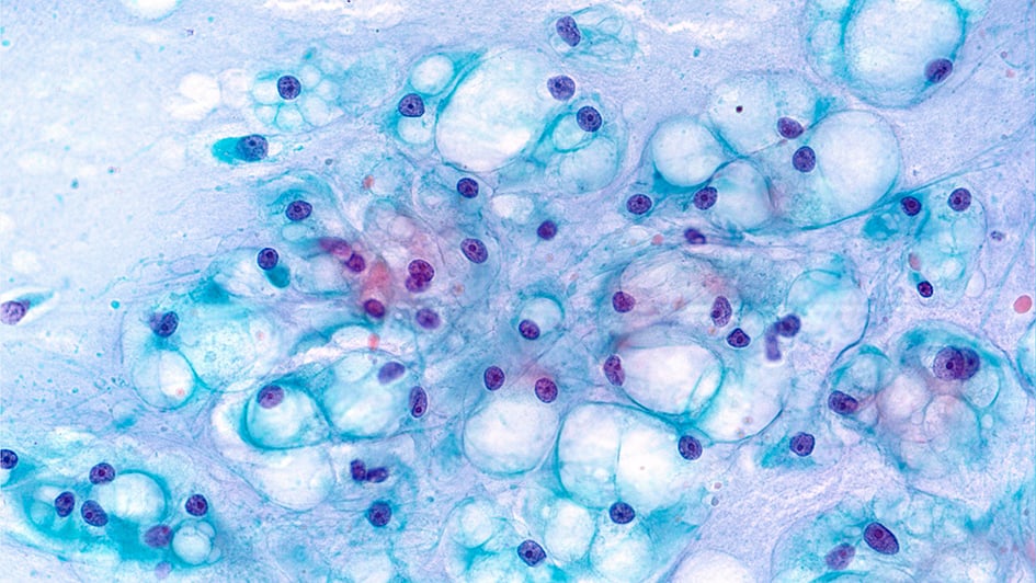 Papanicolaou stained smear of a clival chordoma