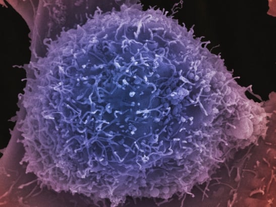 Prostate cancer cell