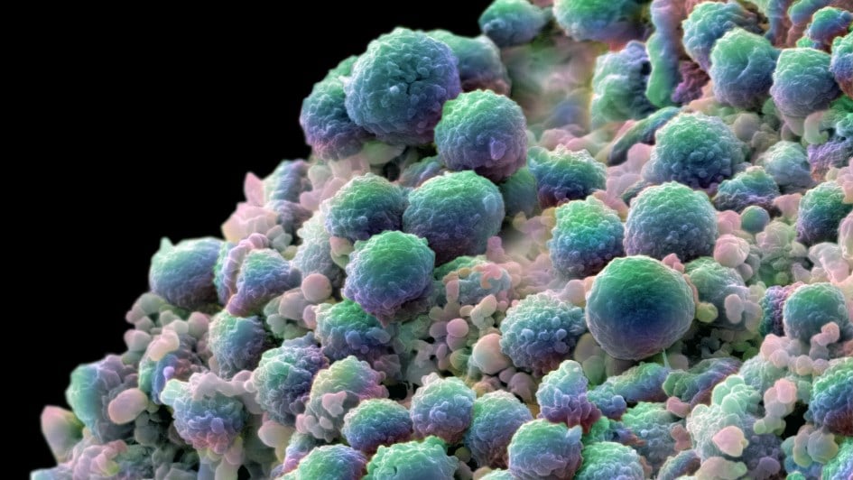 A colour-enhanced image showing a clump of prostate cancer cells