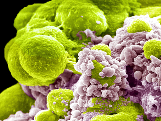 Prostate cancer cells treated with nano sized drug carriers