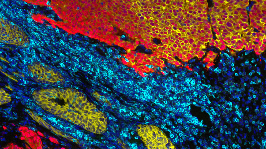 Immunofluorescence staining showing extension of prostatic adenocarcinoma into the bladder wall in a castration resistant prostate cancer patient (Mateus Crespo/Prof Johann de Bono, the ICR)