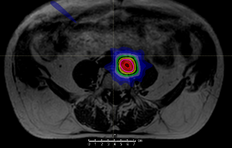 Radiotherapy Plan