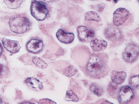 Rhabdoid tumour cells