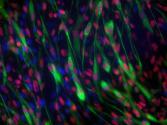 Rhabdomyosarcoma cells content Rhabdomyosarcoma cells (photo courtesy of Dr Ewa Aladowicz in Professor Janet Shipley's team at the ICR)