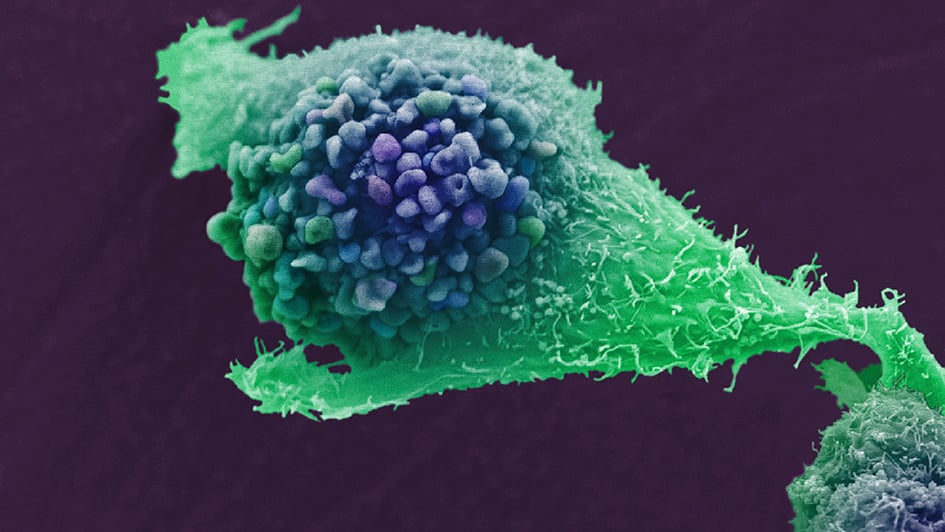 Scanning electron micrograph of a single prostate cancer cell