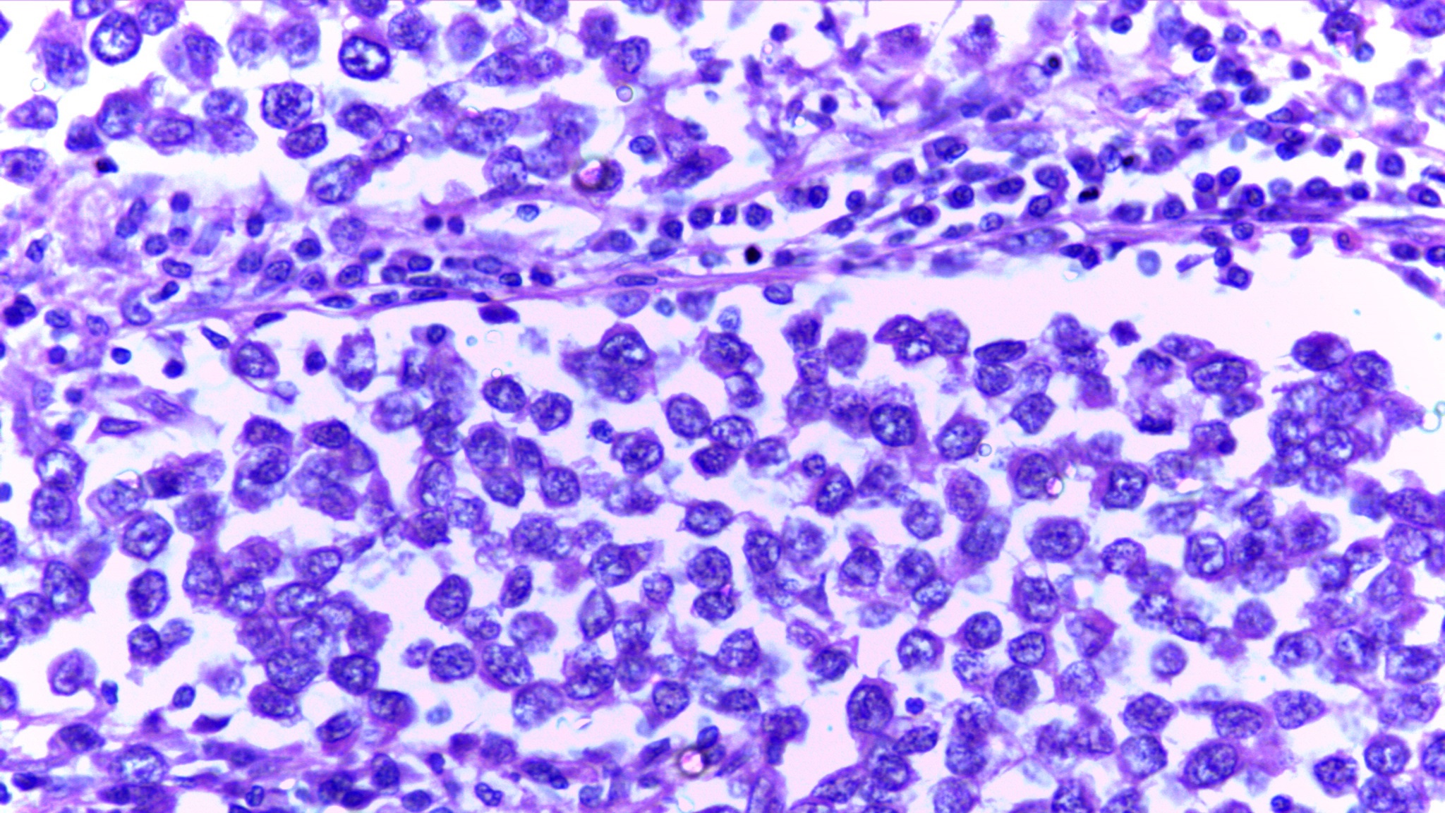 Micrograph of seminoma testes showing lobules of uniform cells separated by delicate septae of fibrous tissue