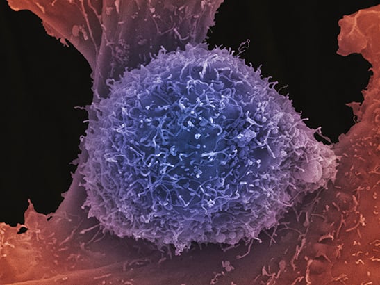 Single prostate cancer cell grown in culture