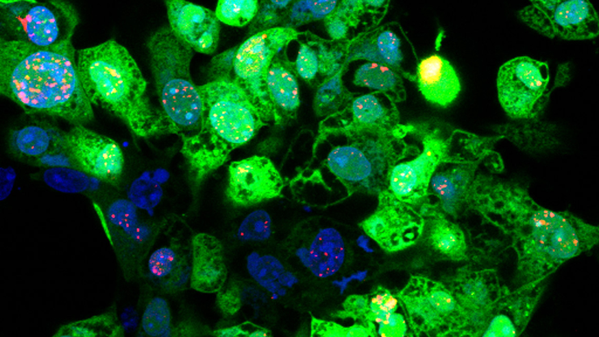 T-vec infected melanoma cells (Green)_Kevin Harrington embed