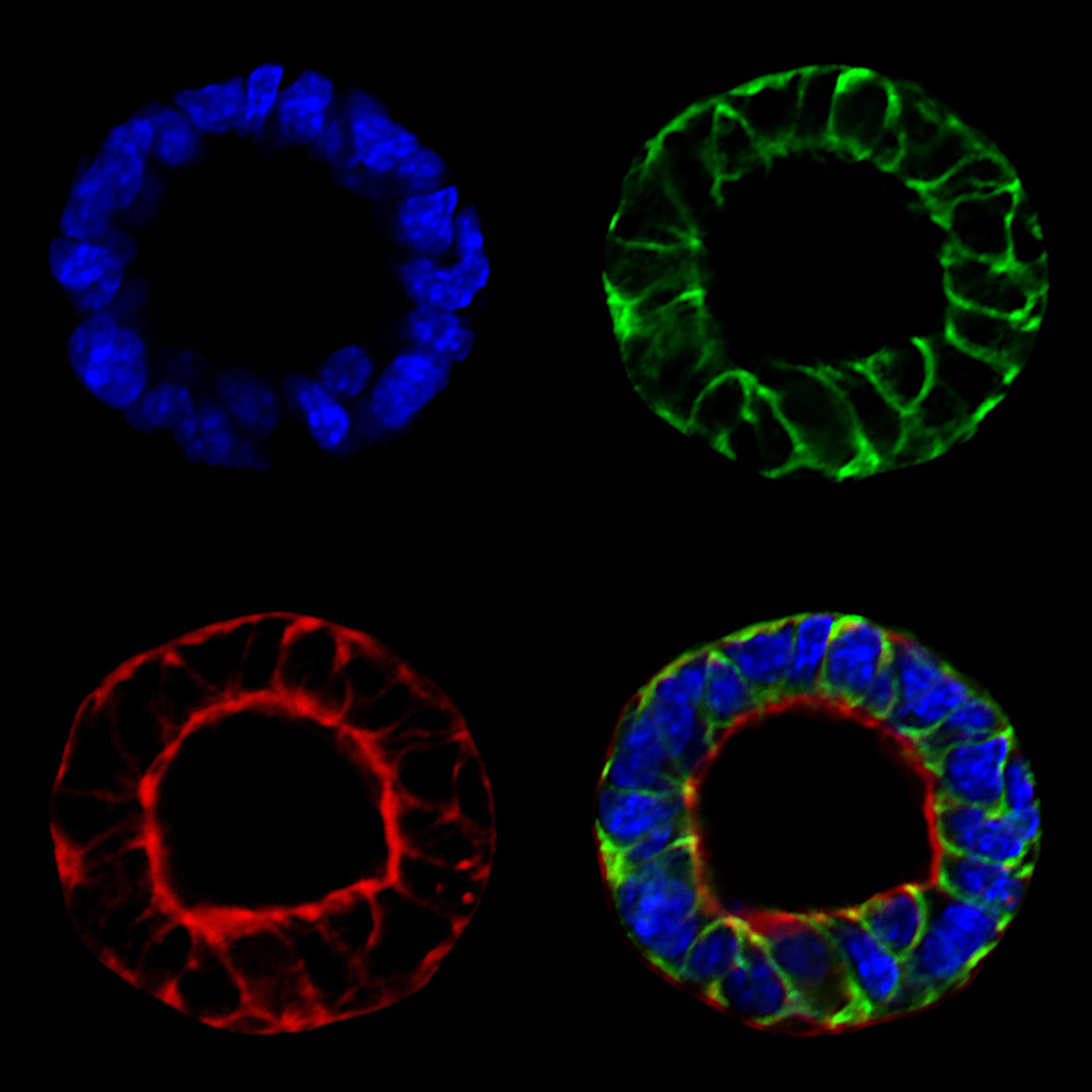 'The Art of Deception' - aggressive breast cancer cells by Dr Jarama Clucas