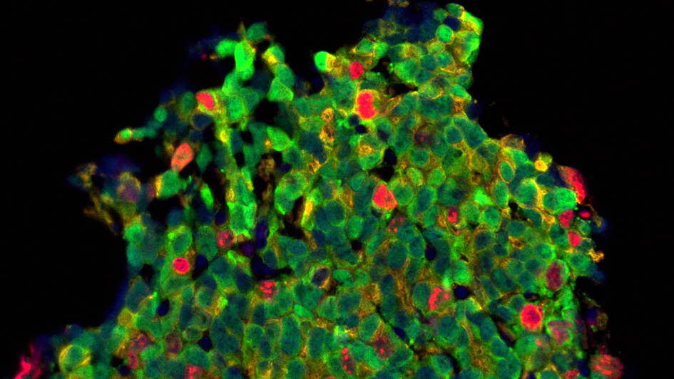 Treated prostate cancer cells (Mateus Crespo/Prof Johann de Bono, the ICR)