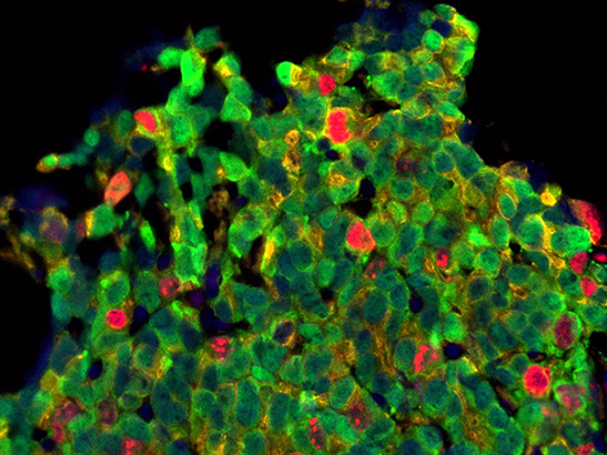 Treated prostate cancer cells (Mateus Crespo/Prof Johann de Bono, the ICR)