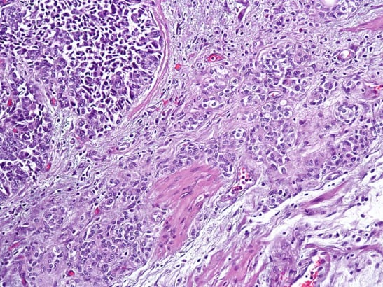 Urothelial_carcinoma_of_the_ureter 547x410