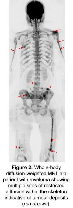 Whole-body diffusion-weighted MRI for myeloma