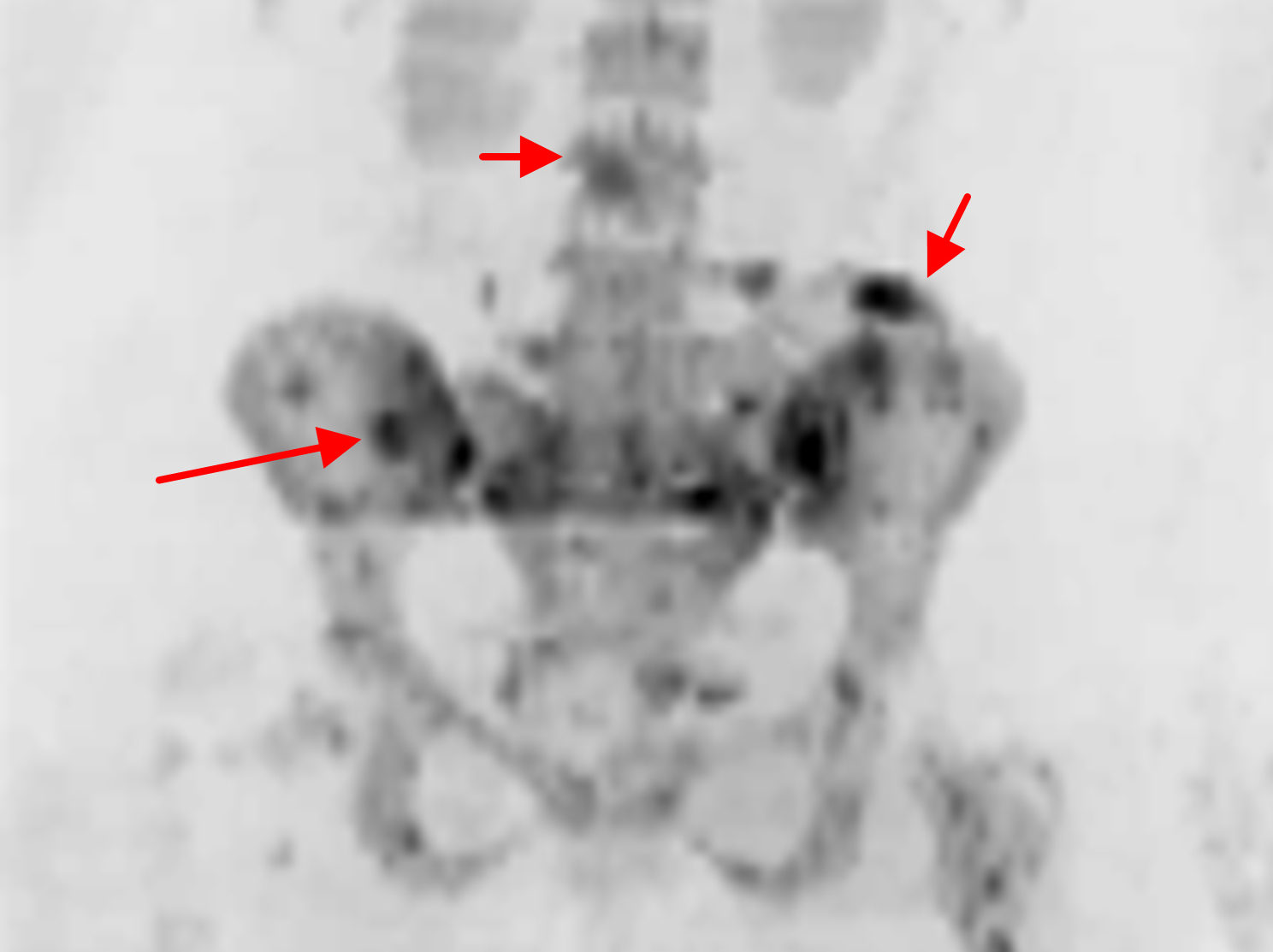 Whole-body diffusion-weighted MRI