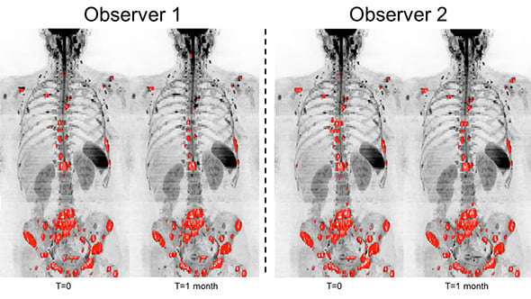 Whole body MRI scans of a breast cancer patient, assessed by two observers, to measure tumours in the patient's bones.  The software could help clinicians reliably assess how bone disease changes over time (image: Blackledge et al 2016)